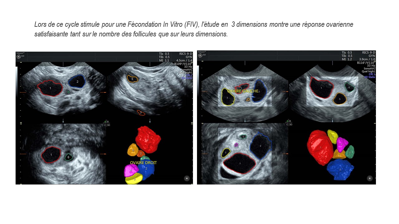 BILAN3