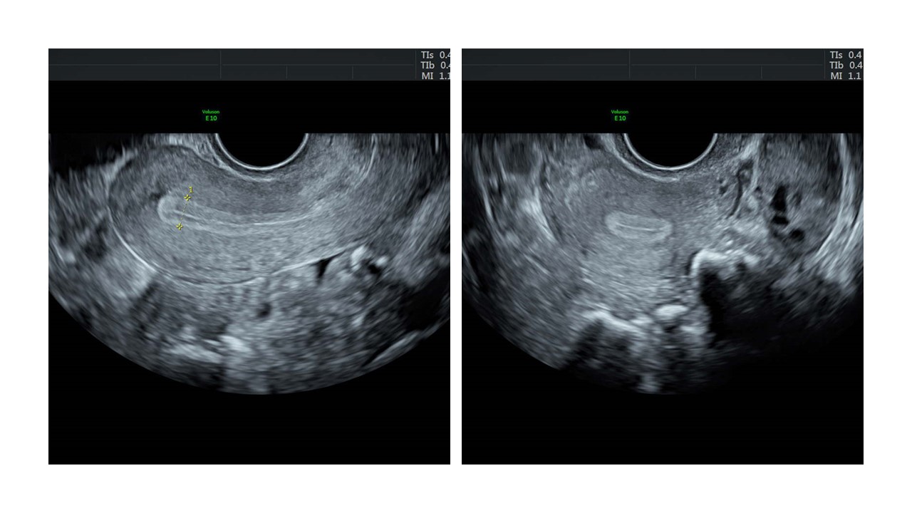 Monitorage coupe transversale de l'utérus